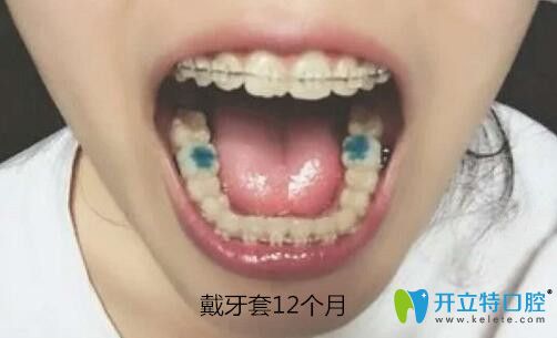 我在梅州中大口腔做陶瓷托槽牙齿矫正12个月