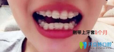 我在梅州中大口腔做牙齿矫正第1个月