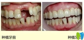 清华阳光口腔种植牙效果