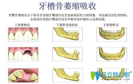 牙槽骨萎缩就不能做种植牙了吗？NO,补救方法来啦！