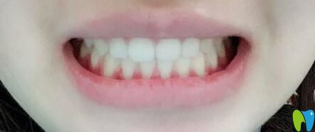 我在西安美立方口腔做牙齿矫正12个月