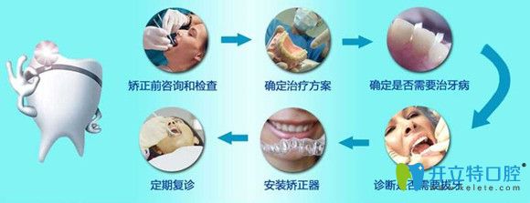正畸知识分享：牙齿矫正详细步骤和过程图解