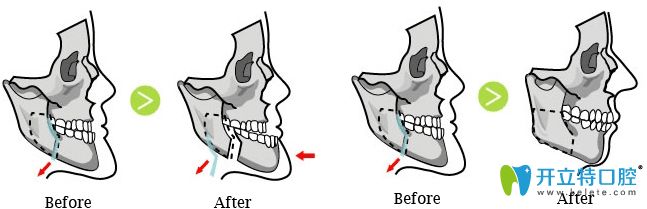 广州广大口腔地包天矫正变化图