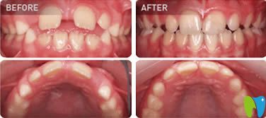 佛山拜尔口腔儿童牙齿正畸前后效果对比图