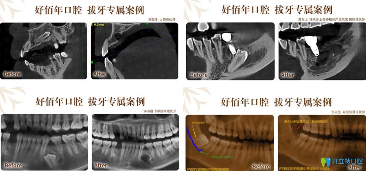 好佰年疑难牙拔除前后对比图