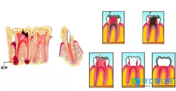 死髓牙怎么治疗