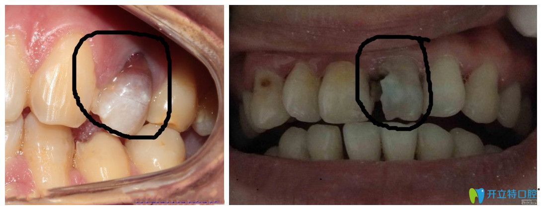 牙髓坏死图片