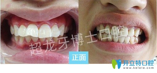 长春牙博士王聪医生成人深覆盖牙齿矫正前后对比案例图