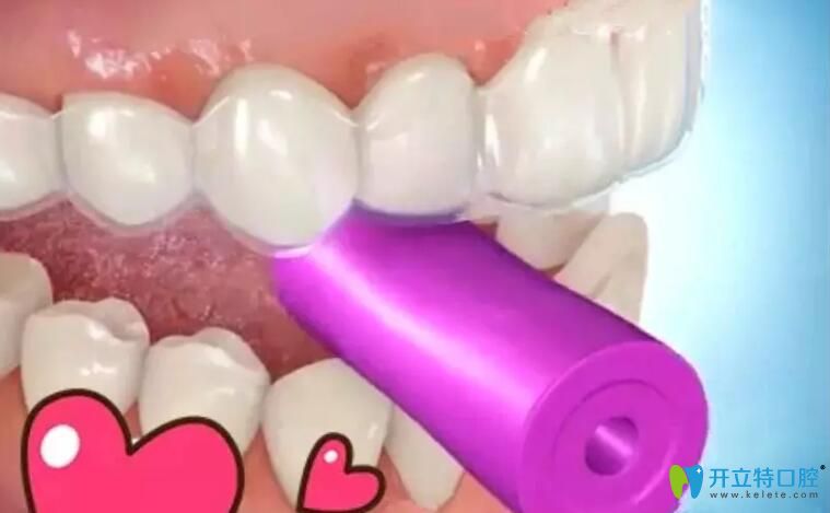 正畸咬胶如何正确咬 正畸咬胶如何正确咬