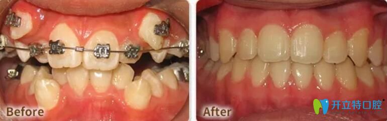东莞好佰年口腔虎牙矫正案例前后效果对比