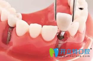 苏州康洁口腔王申讲解种植牙手术过程
