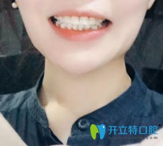 <!--<i data=20240703-sp></i>-->口腔陶瓷托槽隐形矫正术后1年半效果图