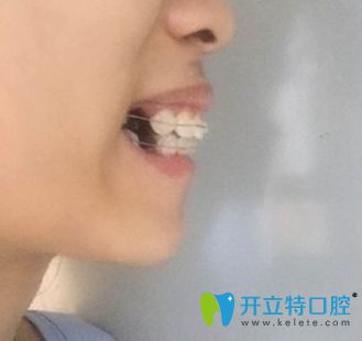 <!--<i data=20240703-sp></i>-->牙科牙齿正畸过程图