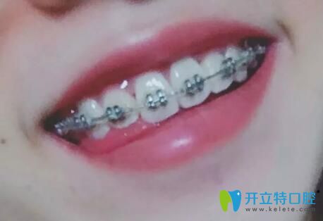 我在北京丽都口腔做牙齿矫正第10个月