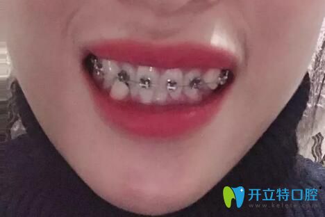 我在北京丽都口腔做金属自锁托槽牙齿矫正第3个月