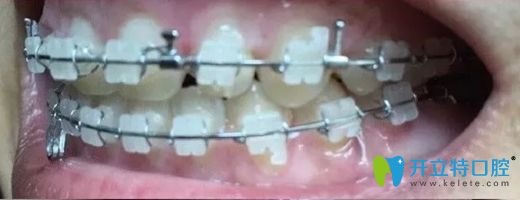 北京康贝佳口腔陶瓷牙套正畸7个月牙齿侧面效果图