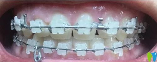 北京康贝佳口腔牙齿矫正7个月效果变化图