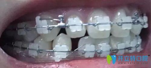北京康贝佳口腔刚戴牙套时牙齿稀疏的照片