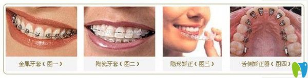 牙齿矫正的不同分类 牙齿矫正的不同分类