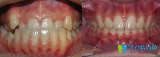 郑州德正口腔牙齿反颌正畸前后效果对比图