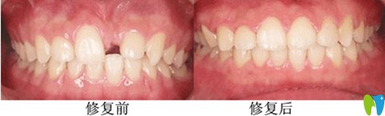 郑州德正口腔前牙美学种植前后效果对比图