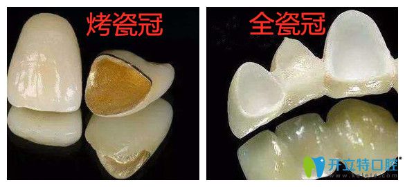 牙冠不同种植牙价格也不同 牙冠不同种植牙价格也不同