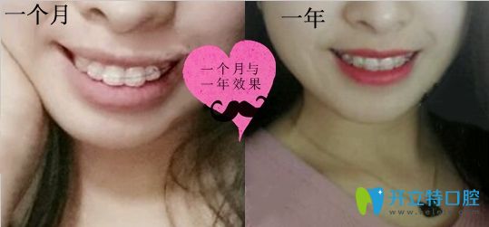 深圳润泽瑞尼丝口腔矫正一个月和一年效果对比图