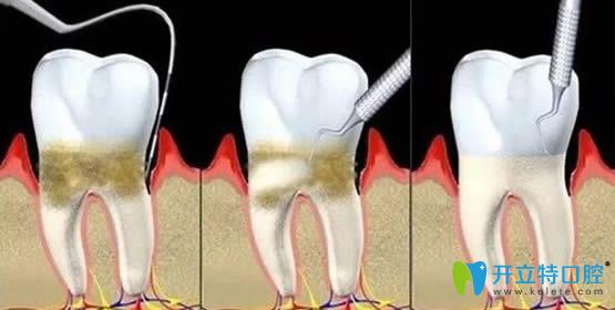 牙周治疗仪的作用和工作原理