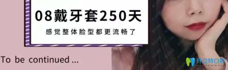 拥挤牙齿在圣贝口腔矫正250天照片