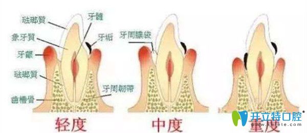 牙龈萎缩的三种情况 牙龈萎缩的三种情况