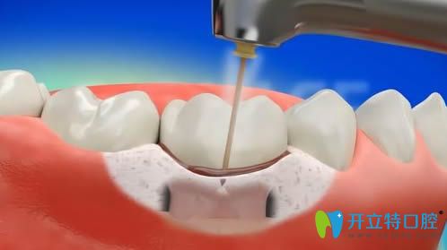 牙周治疗仪可提高牙周病和根管治疗的有效性
