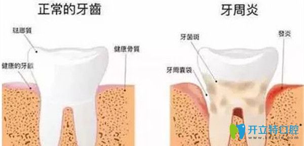 正常的牙齿状况及牙周炎的状况 正常的牙齿状况及牙周炎的状况