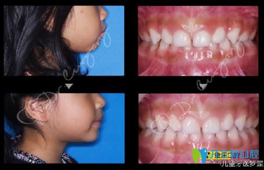 罗罡博士儿童深覆合矫正前后效果对比图