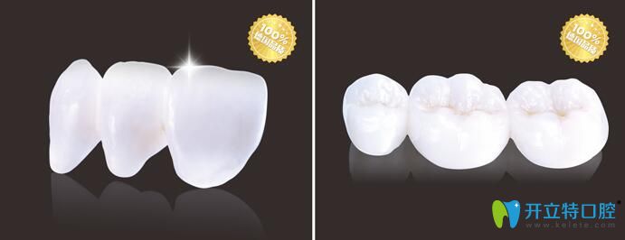 叶一了医生特色项目格莱美3D全瓷冠