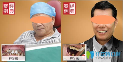 广州广大口腔半口牙种植案例效果图 广州广大口腔半口牙种植案例效果图