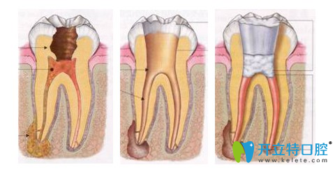 重庆维乐口腔黎辉医生介绍牙体牙髓病的应急治疗方法
