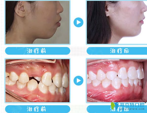 <!--<i data=20240703-sp></i>-->成人隐适美矫正案例对比图