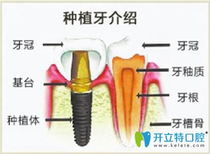 福州中泽口腔许珍龙擅长种植牙