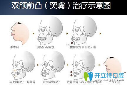 广州广大口腔正颌治疗示意图