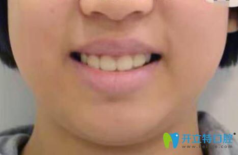 12岁女儿在福州中泽口腔做牙齿矫正12个月