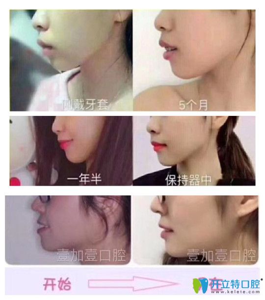 广州壹加壹口腔牙齿矫正实例疗效对比图 广州壹加壹口腔牙齿矫正实例疗效对比图