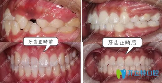 佛山春芽口腔郑旭辉牙齿矫正前后效果图