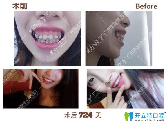 广州壹加壹口腔露龈笑矫正前后脸型变化图效果对比