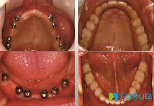 深圳诺德齿科全口种植牙效果图