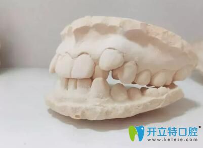 我在广州壹加壹口腔做牙齿矫前的牙膜