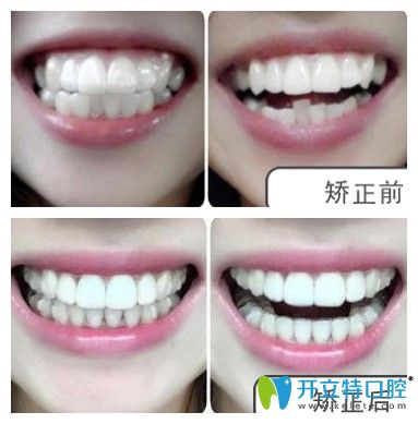 衡阳雅美口腔顾客矫正案例图 衡阳雅美口腔顾客矫正案例图