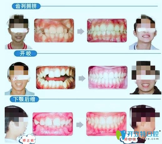 长沙中诺口腔青少年牙齿矫正案例