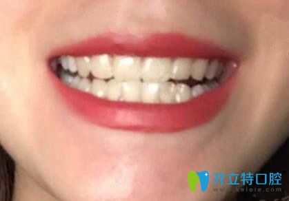 我在广州壹加壹口腔做牙齿矫正戴保持器