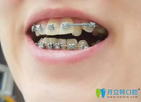 我在广州壹加壹口腔做牙齿矫正第9个月