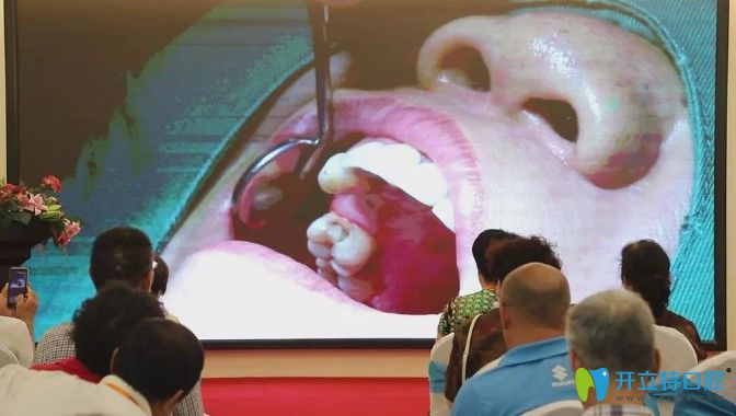 天津中诺口腔立得用种牙手术图 天津中诺口腔立得用种牙手术图